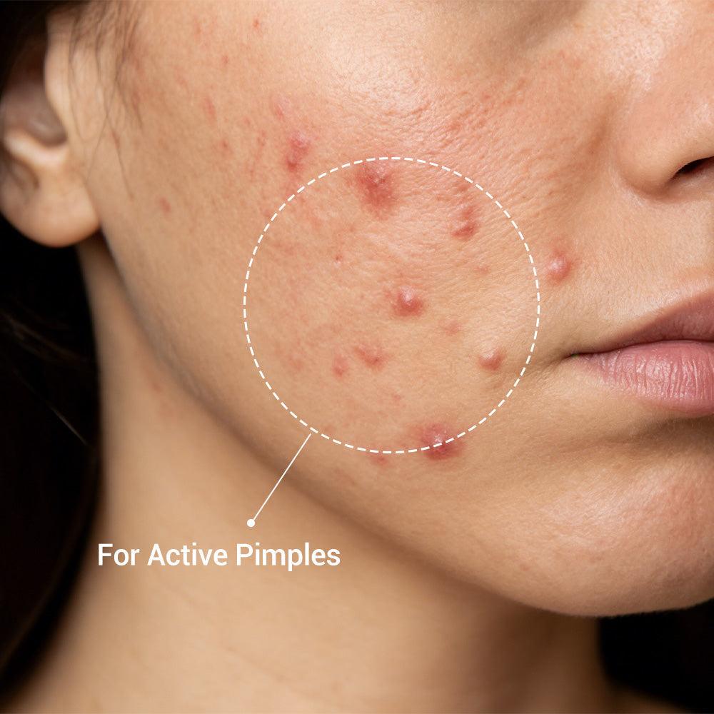 Salicylic Acid Drying Lotion for Acne, Breakouts & Oily Skin