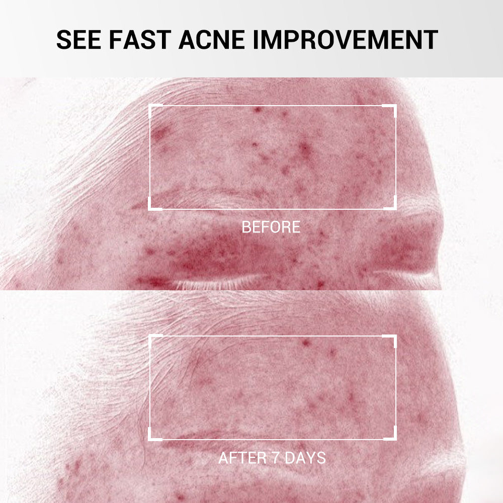 Salicylic Acid Drying Lotion for Acne, Breakouts & Oily Skin