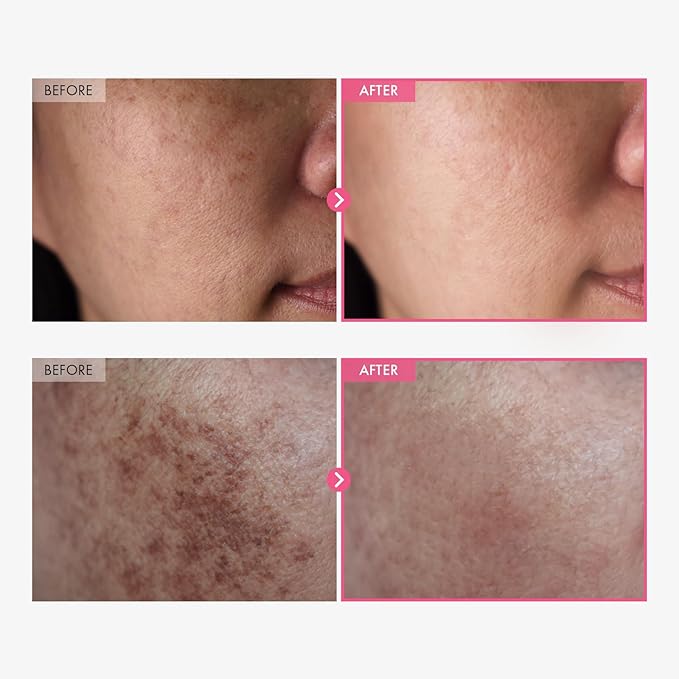 Arbutin 7% & Tranexamic Acid 4% Cream with Niacinamide for Dark Spots