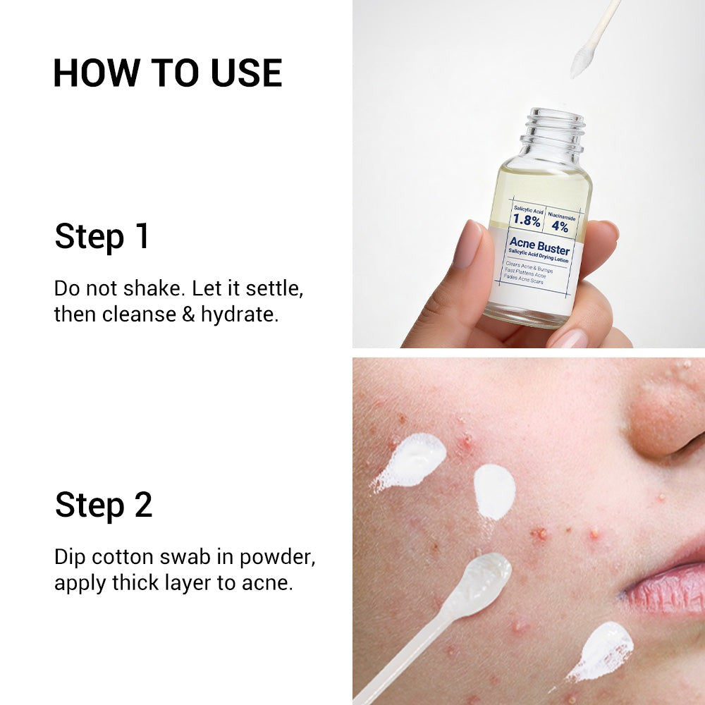 Salicylic Acid Drying Lotion for Acne, Breakouts & Oily Skin